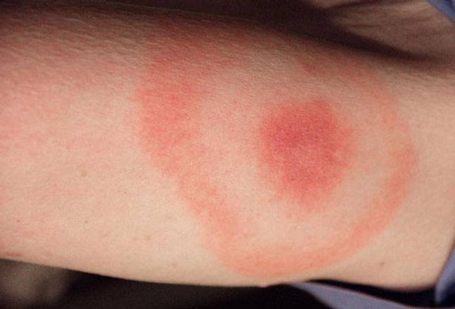 cdc_photo_of_lyme_disease_bullseye_rash-1169782645.jpg