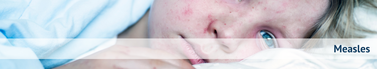 Measles banner2.png